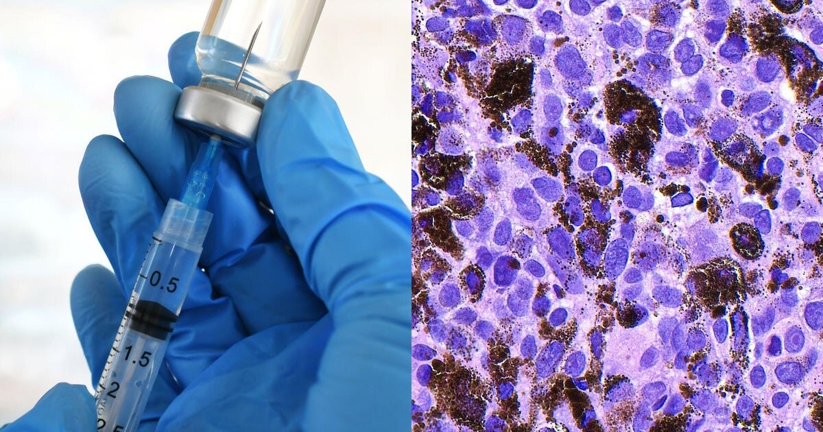 This mRNA vaccine could potentially prevent the return of the deadliest form of skin cancer