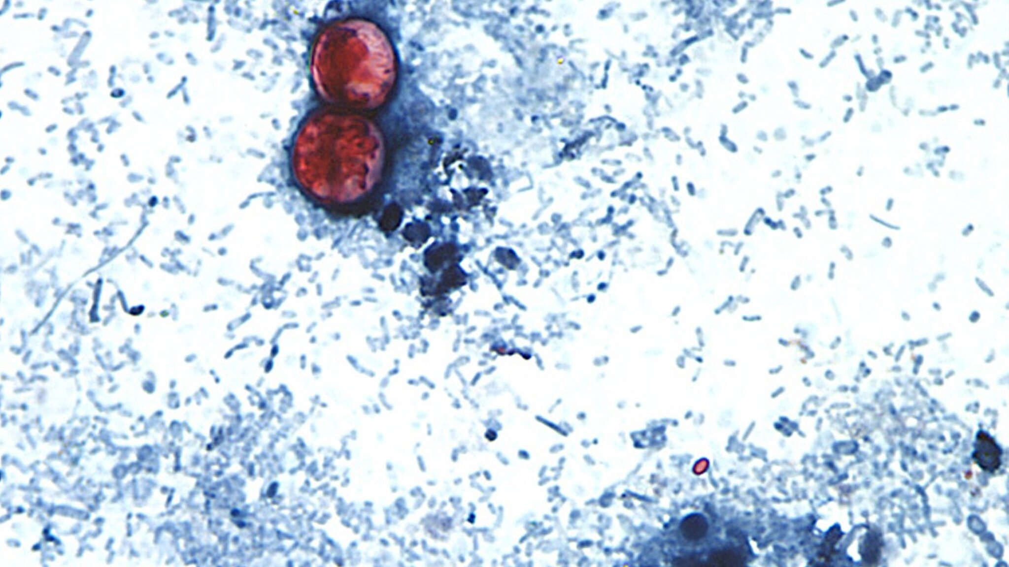 More than 18,000 cyclosporiasis cases reported across 45 states: CDC