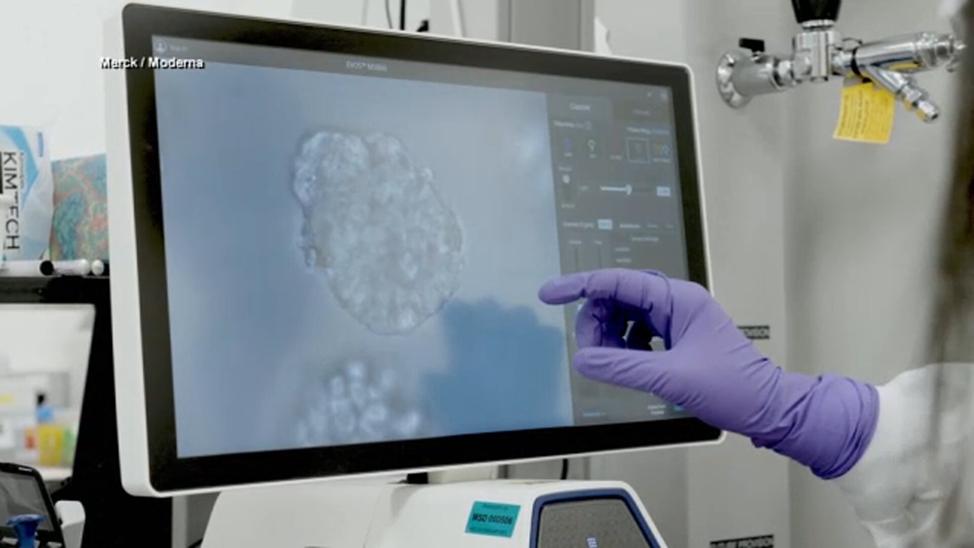Personalized mRNA cancer vaccine shows promise in extending life span in melanoma trial