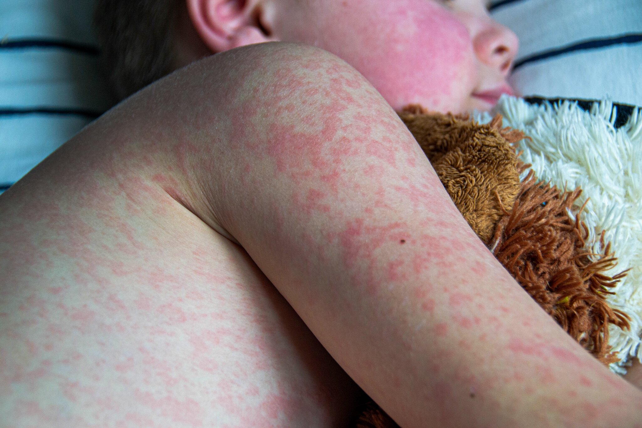 Two unvaccinated people die from measles in Pennsylvania, officials confirm
