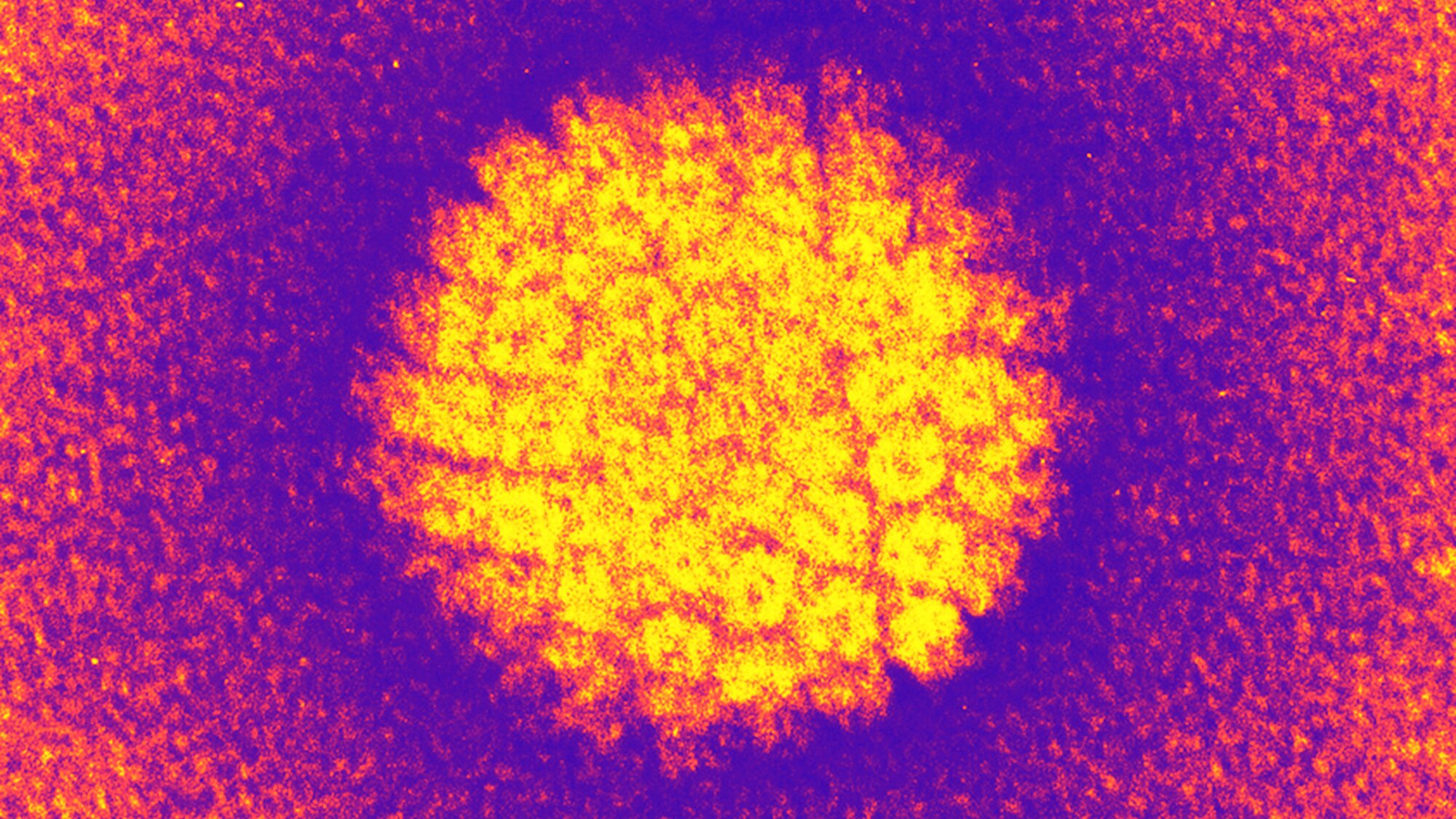 As cervical cancer rates fall, HPV is causing more throat and mouth cancers in men