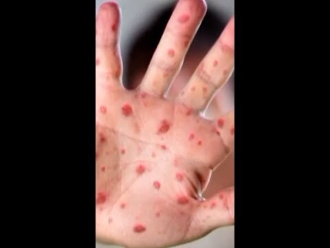 Pennsylvania reports year's first measles deaths in U.S.