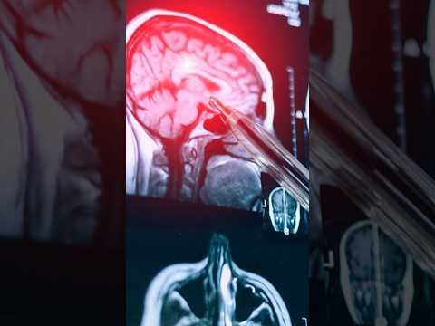 Study: 1 in 4 NFL players who died in 5-year span had CTE