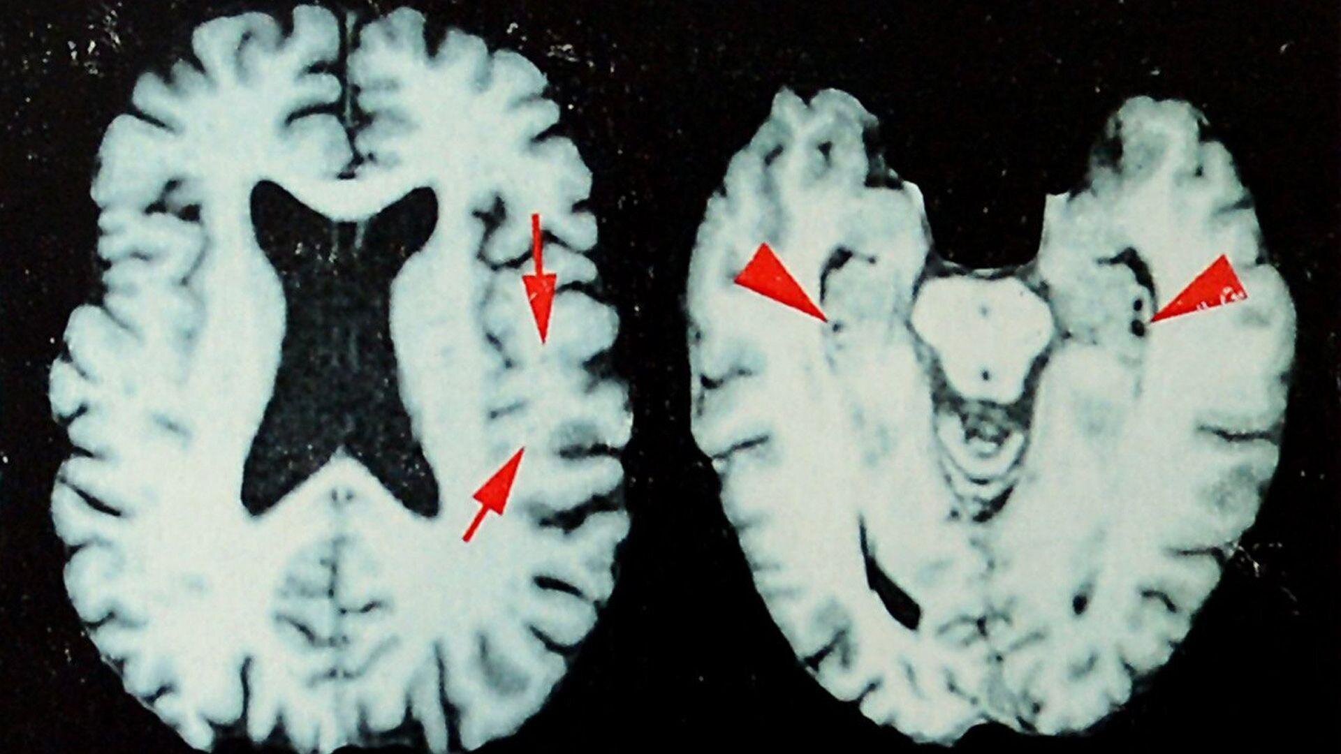 Brain disease in dead NFL players 'higher than previously shown
