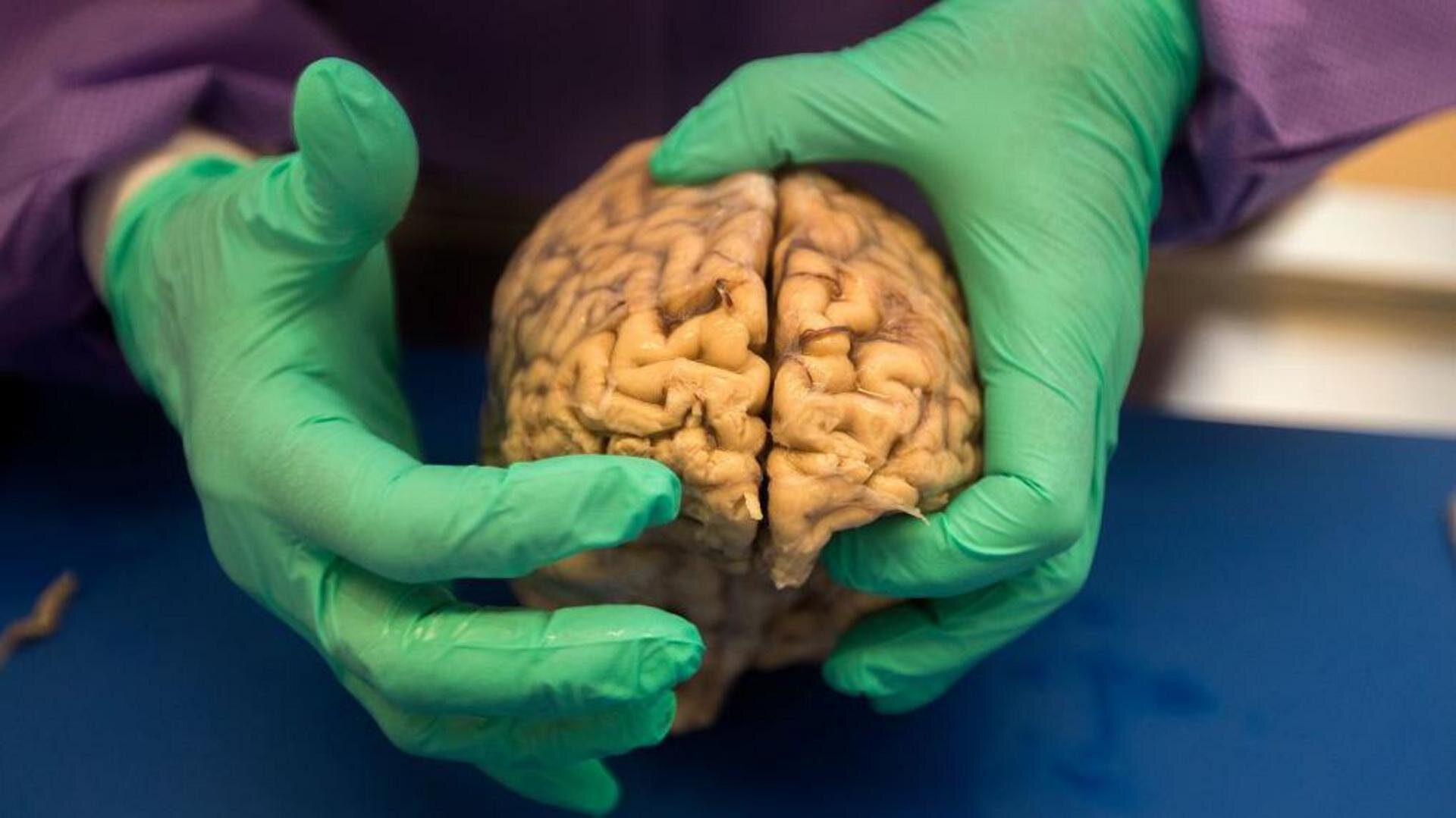 Brain disease in dead NFL players 'higher than previously shown