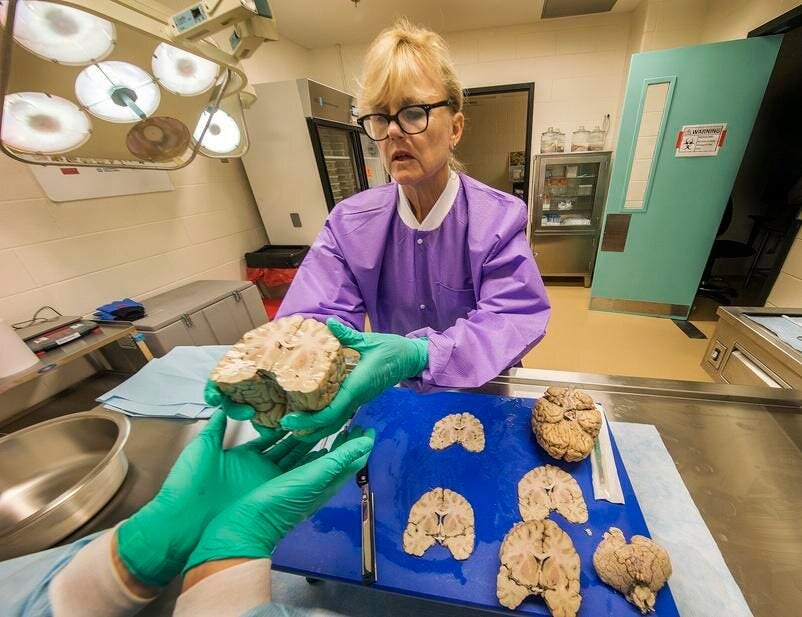 New Study: 1 In 4 NFL Players Had CTE At Death