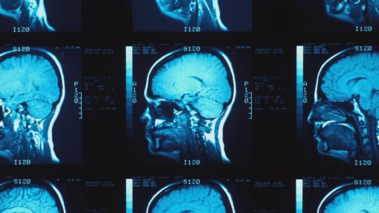 Wake-up call’: At least 1 in 4 ex-NFL players had CTE, new Mass General Brigham study finds