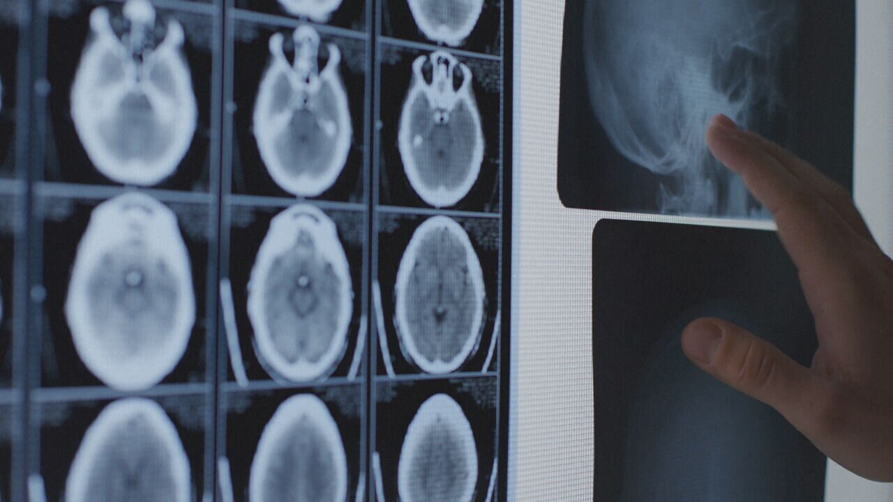 Study finds 25% of deceased NFL players had CTE