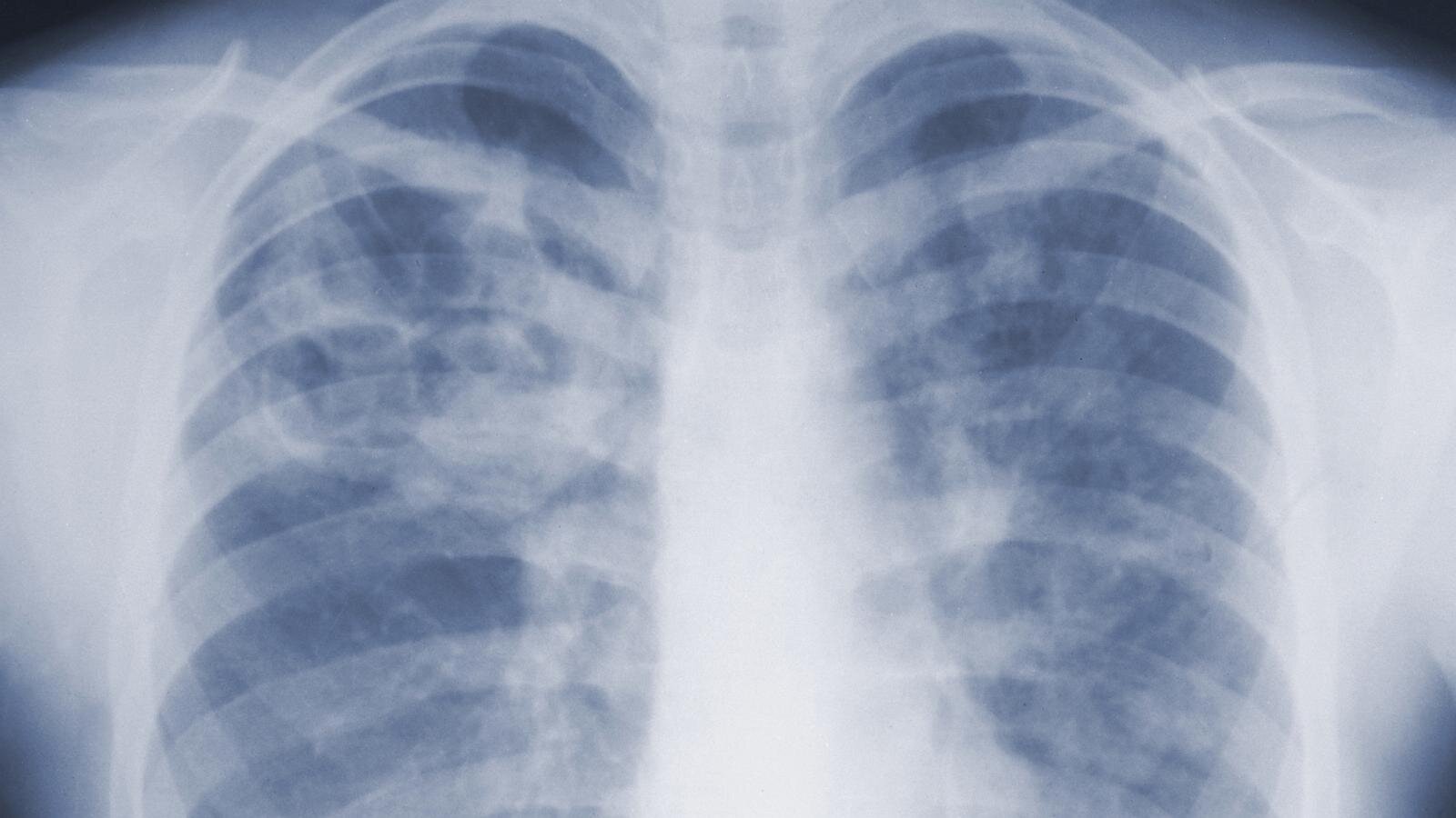 Study suggests the threat of mold-associated illnesses may be underappreciated