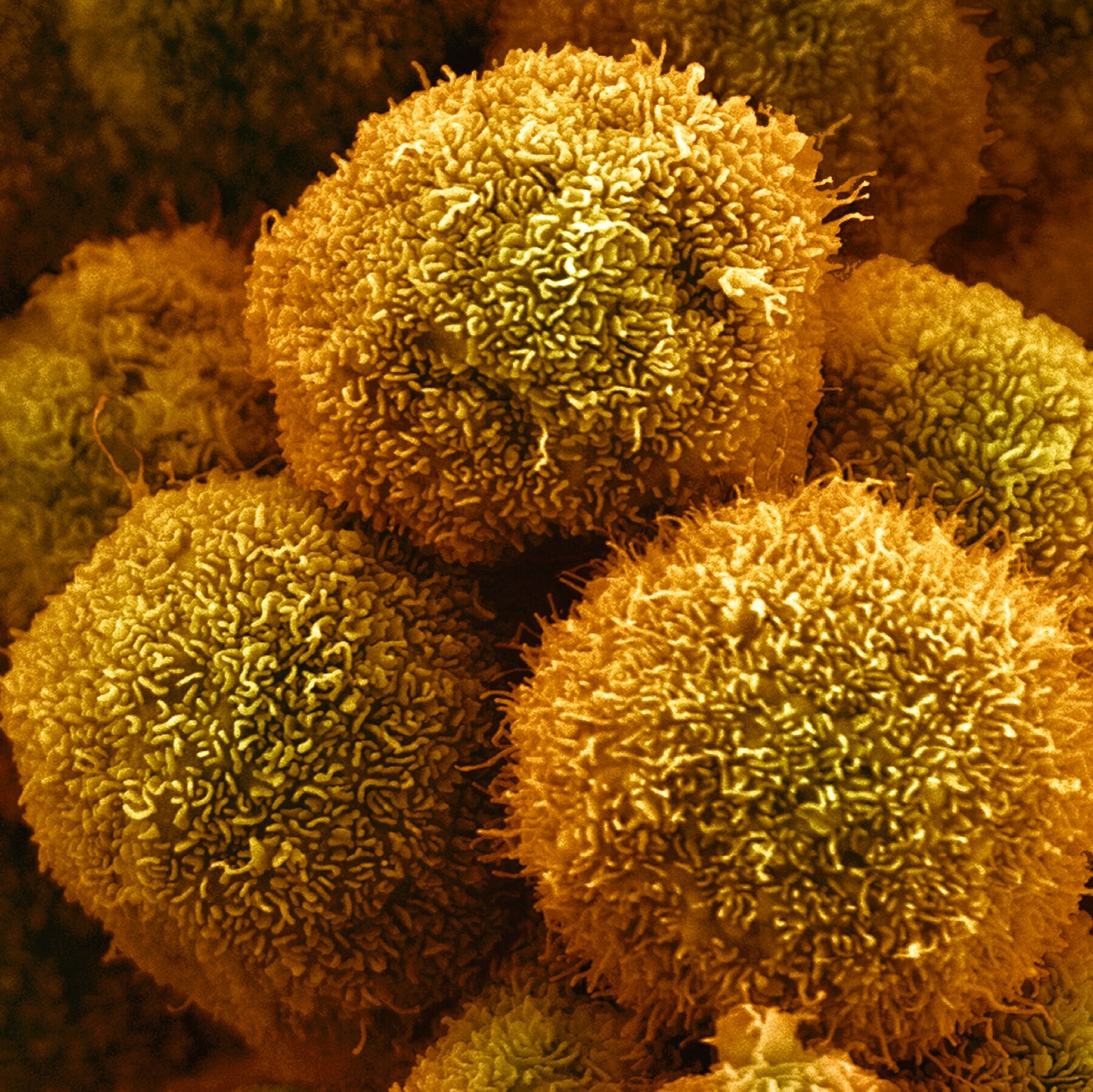 New Drug Approved by F.D.A. for Pancreatic Cancer Could Be First of Many