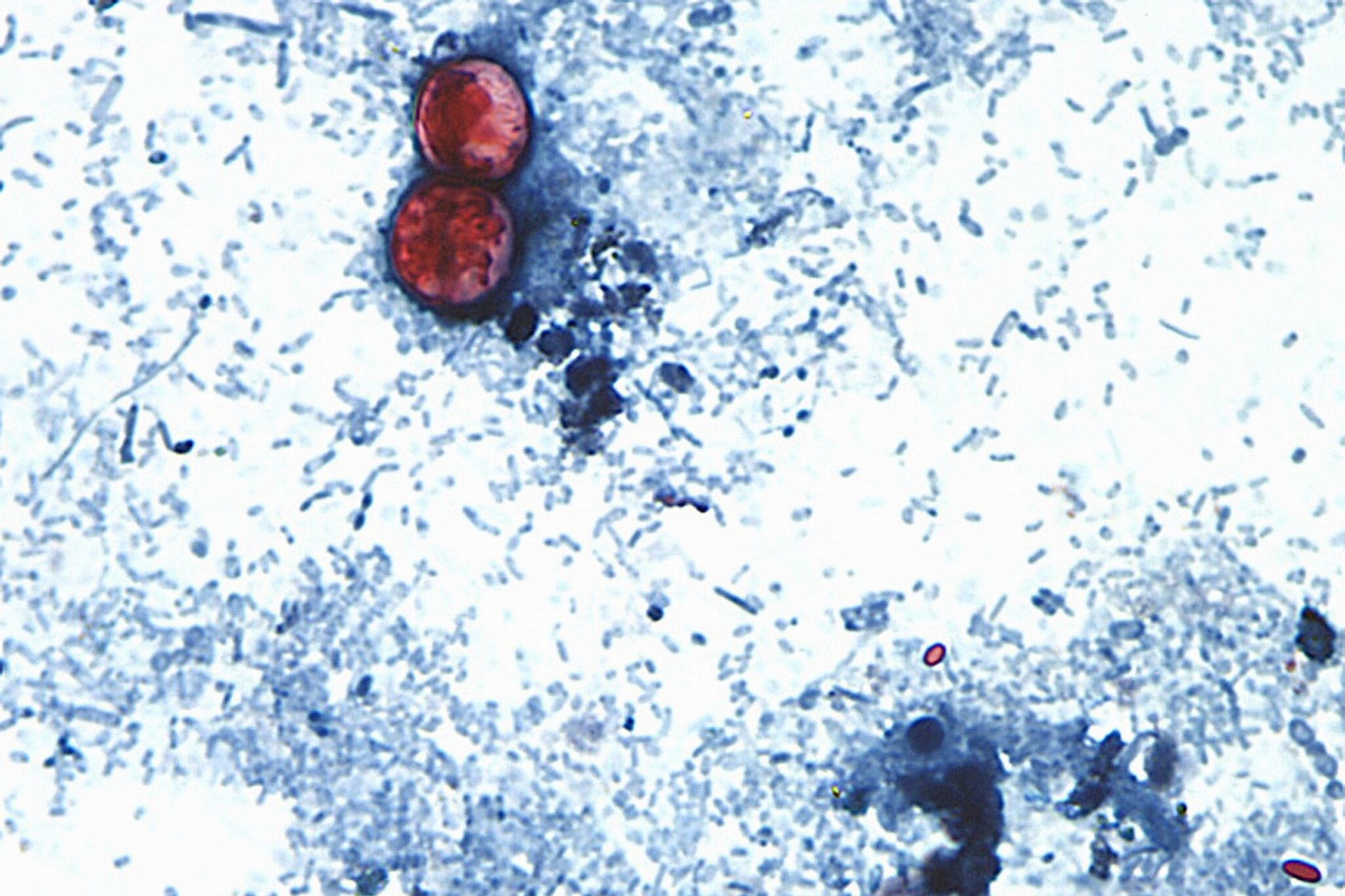 US announces first two deaths from cyclospora outbreak