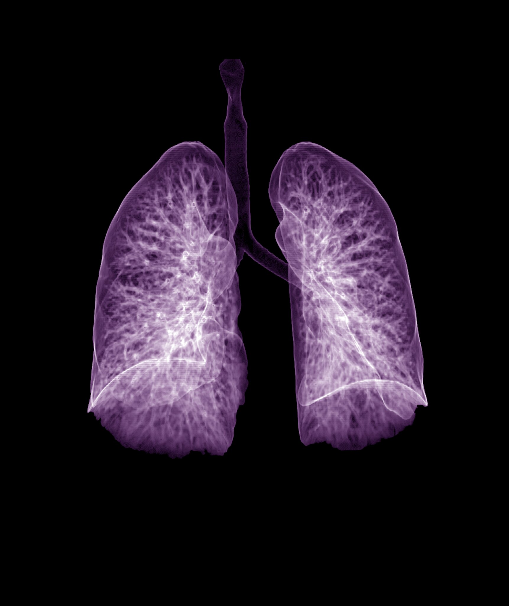 STAT+: Sionna’s experimental cystic fibrosis pill falls flat in mid-stage trial